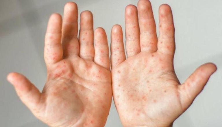 خبر-انفلونزا-الطماطم-فيروس-جدي